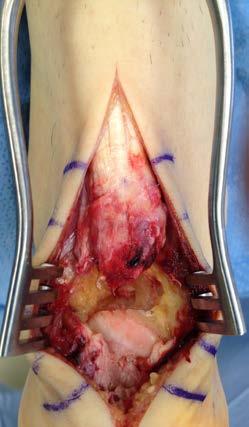 Insertional Achilles Ruptures Nonsurgical treatment?