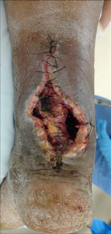 Complications Infection Wound problems Superficial vs.