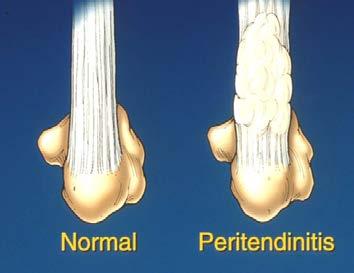 Staging Stage 1 = Peritendinitis Inflamed peritenon