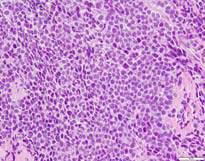 Neuroblastoma Medullary carcinoma