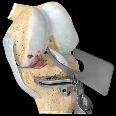 Insert a headless trocar pin through the center of the 12 mm vertical slot to set the position of the sagittal cut slot (Figure 13).