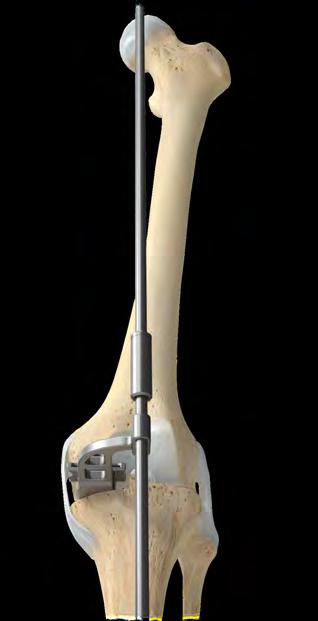 13 Persona Partial Knee System Surgical Technique Figure 23 Figure 24 Verifying Limb Alignment Two options are available for verifying limb alignment.