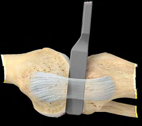 15 Persona Partial Knee System Surgical Technique Figure 27 Figure 28 Confirming the Flexion and Extension Gaps Select the flexion/extension gap checker thickness that matched the spacer block