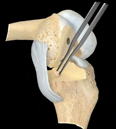 Take care to avoid damage to the medial collateral and anterior cruciate ligament. Remove the headed screws and the femoral finishing guide checking to make sure all cut surfaces are flat.