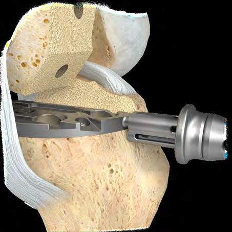 24 Persona Partial Knee System Surgical Technique Figure 45 Figure 46 Finish the Tibia (cont.