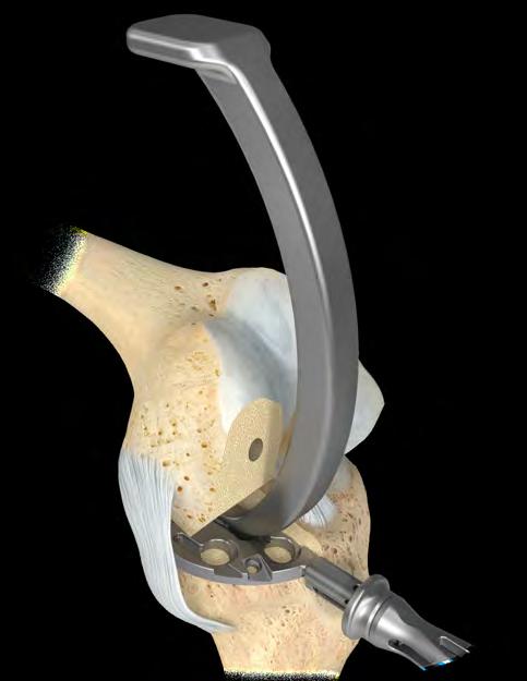If necessary, insert the tibial impactor into the recess on the tibial trial and impact so it sits flush