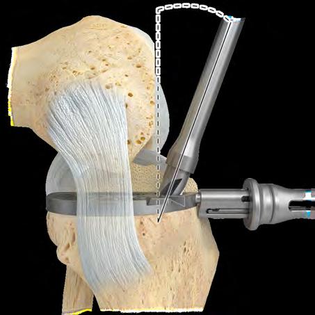 order to resist posterior shift of the tibial trial in the event overtightening of the 33 mm