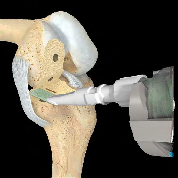 28 Persona Partial Knee System Surgical Technique Figure 55 Implanting Final Components Obtain the final components. Due to space constraints the tibial component should be implanted first.