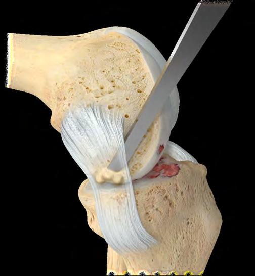 deformity. If there are large osteophytes around the patella they can also be removed.