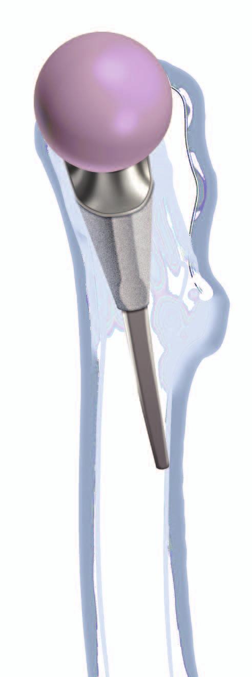 Metha Short Hip Stem System Designed For Anatomic Accuracy The Metha Short Hip Stem is
