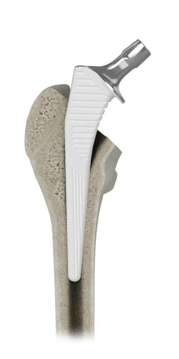 Figure 11: Femoral Implant Placement Figure 12: Femoral Implant Insertion 7.