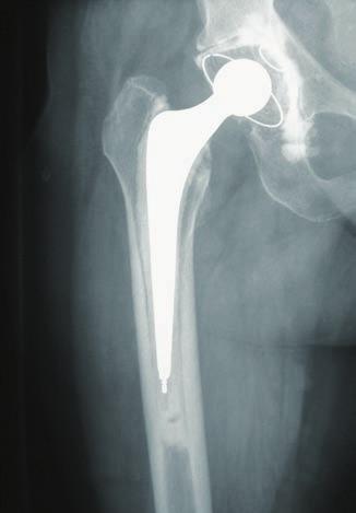 Case Reports Case 1: Endofemoral Approach 77-year-old patient with aseptic
