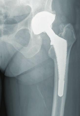 Case 2: Transfemoral Approach Postoperative X-ray; noncemented revision via