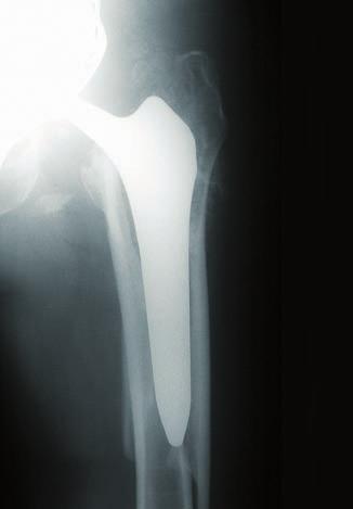 Case 3: Periprosthetic Fracture 84-year-old man with periprosthetic fracture after cup revision. X-ray 1 year postoperative after revision with a Revitan Curved Stem.
