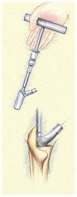 Cone Body Trial Assemble the Appropriate Cone Body Trial to Conical Distal Stem Select the Cone Body Trial corresponding to the final Proximal Cone Reamer diameter and proper height based on the