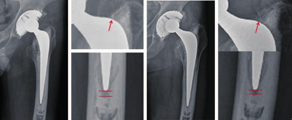 Jin-Young Park et al. Long-term Outcome of Polished Stems in Total Hip Arthroplasty for 3-5 days followed by 5-7 days of wheelchair assisted walking.