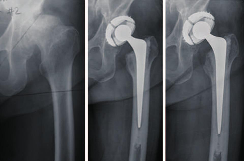 Hip Pelvis 27(2): 83-89, 2015 identified nine patients as grade C and no one as grade D (Table 3). The average subsidence of femoral stem was 1.9 mm (0.5-4.