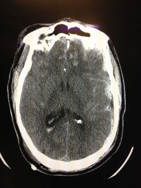Case #1 CT head: Diffuse b/l SAH DAI small SDH B/L