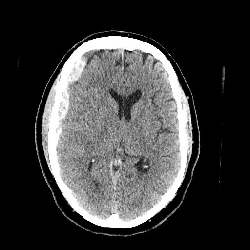 CT Results Acute subdural hemorrhage along the right cerebral convexity Subdural hemorrhage along the right tentorium.