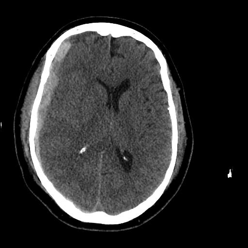 Morning CT of the Head Slight increase in the bleed along