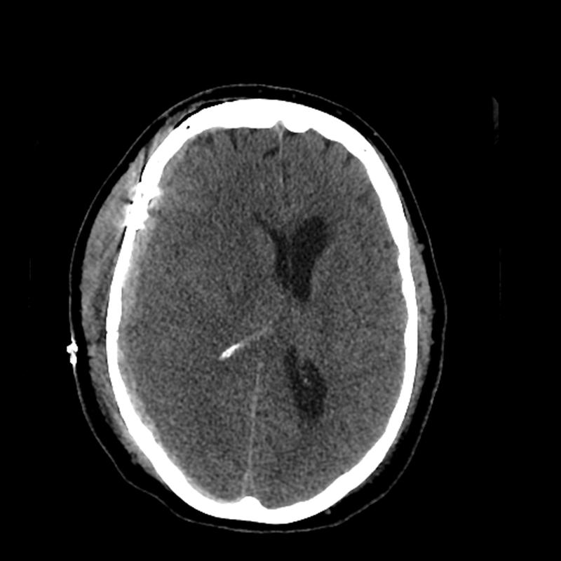 POD #3 Ventriculostomy placed: ICP s = 39 (ordered at