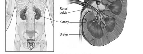 extension into the renal vein has been downstaged from a T3b to a