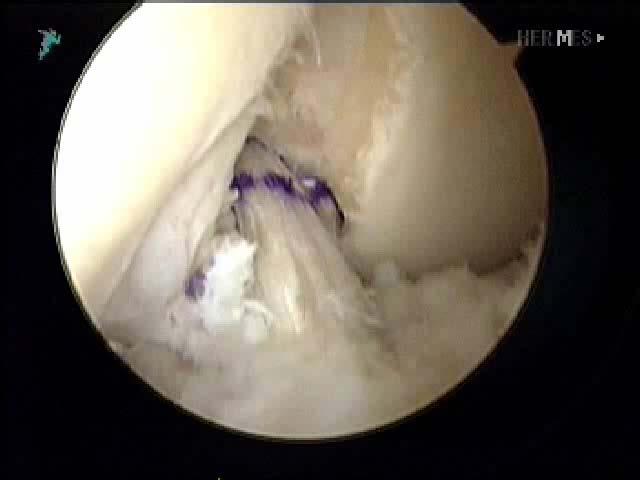 Double vs. Single Bundle ACL Reconstruction The relatively small improvements in laxity from adding a PL graft may not be worth the high graft forces necessary to achieve them.
