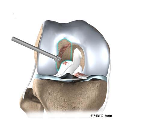 Inadequate Notchplasty ACL graft often larger than native ACL Need clearance between graft and roof of notch Notch large enough to accommodate full ROM Inadequate notchplasty Impingement in extension