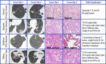 SYNCHRONOUS CARCINOMA STAGING AJCC 7 TH EDITION When multiple tumors are of the same cell type, they should only be considered to be synchronous primary tumors if in the opinion of the pathologist,