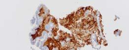 NET: Cytology and IHC Index Case : Additional IHC on de stained slides performed at