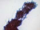 Cytology  IHC SFT is