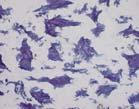 Synovial Sarcoma: IHC Synovial Sarcoma: IHC IHC to support the diagnosis of