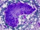 focal staining for EMA PAP, 4x DQ, 4x DQ, 40x DQ, 40x MPNST Smooth Muscle Tumors: