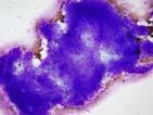 Leiomyosarcoma: Cytology