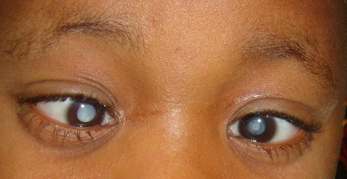 Leukocoria (white reflex) Cataracts
