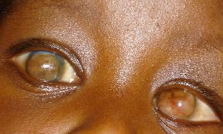 corneal ulcer, melting and later scarring Causes / Risk