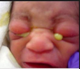 Ophthalmia neonatorum Conjunctivitis of the newborn occurring within 30 days of life Eye discharge +/- swollen eyelids Causes Neisseria gonorrhea Chlamydia Viruses Traditional eye medicine Risk