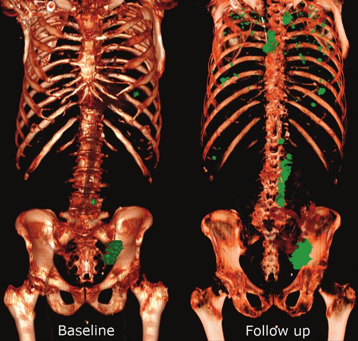 468 March-April 2018 radiographics.rsna.org Figure 4. Three-dimensional CT image pair in a 72-year-old man with bladder cancer shows all metastatic lesions and their progression over time.