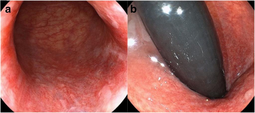 Histopathological examination of biopsy specimens showed many Paget s cells within intraepithelial lesions of the perianal skin but no malignant cells in the rectal or vaginal mucosa.