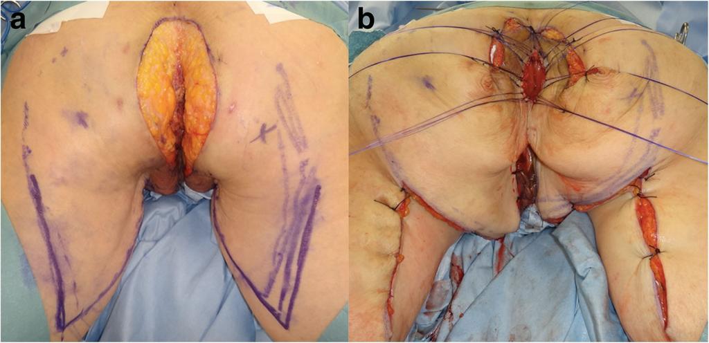 Ishioka et al. Surgical Case Reports (2018) 4:63 Page 3 of 5 Fig. 3 Surgical findings. a Anal-preserving wide local excision deep to the subcutaneous fat.