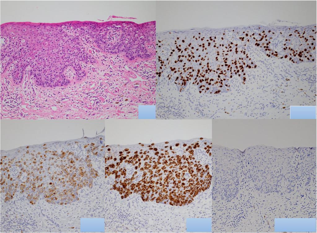 The expression of CDX2 is a sensitive and specific marker for the secondary type, arising from anorectal or colonic adenocarcinoma [7], but CDX2 fails to distinguish primary disease from EMPD