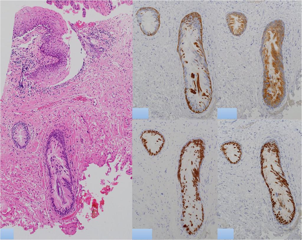 Conclusions This case report indicates that the symptomatic pagetoid changes in the perianal skin without a visible tumor in the rectum should raise the suspicion of pagetoid spread from anal gland