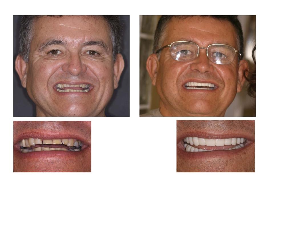 Worn out teeth, collapsed bite, metal and mercury replaced with porcelain restorations to open his vertical dimension replaced tooth structure and restored the ability to eat.