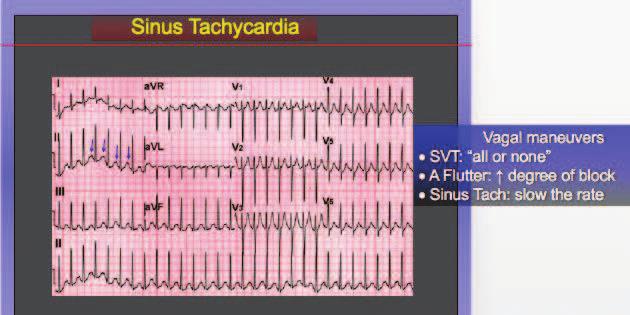 An Approach to Diagnosing Supraventricular Tachycardias on the 12