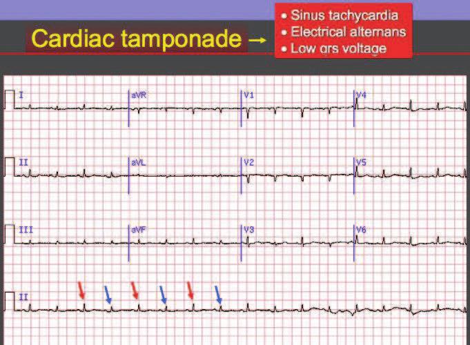 6 Interpreting Cardiac Electrograms - From Skin to Endocardium Figure 3.