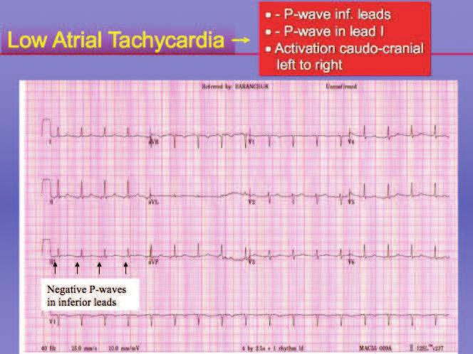 Atrioventricular nodal re-entrant tachycardia (AVNRT) Patients with AVNRT demonstrate dual AV nodal physiology, fast pathway with long