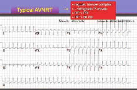 An Approach to Diagnosing Supraventricular Tachycardias on the 12-Lead ECG http://dx.doi.org/10.5772/intechopen.70143 7 has dual AV nodal physiology, only a minority of them develop AVNRT.