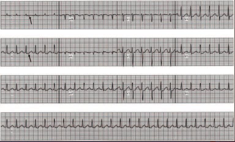 An Approach to Diagnosing Supraventricular Tachycardias on the 12-Lead ECG http://dx.doi.org/10.5772/intechopen.70143 9 Figure 8.