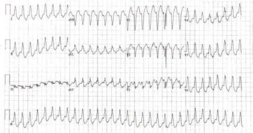 conduction consistent with VT. 4.