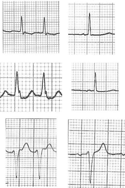 Short RP narrow QRS tachycardia: Utility of the avl lead in the electrocardiographic